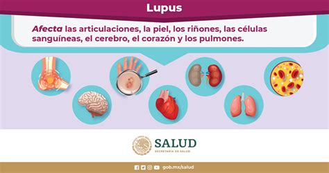 Órganos afectados por el Lupus