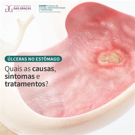 Úlcera estomacal