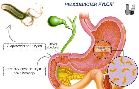 Úlcera por H. pylori