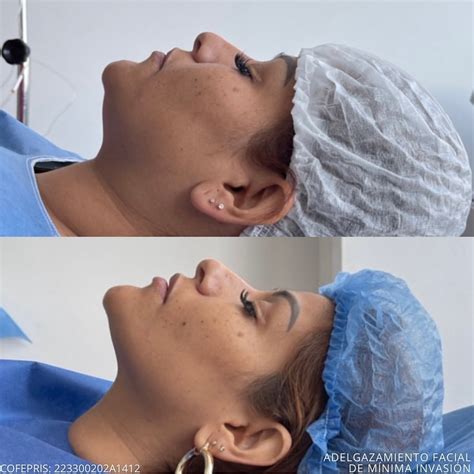 Adelgazamiento Facial