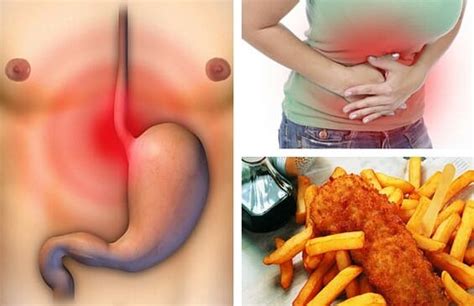 Alimentos prohibidos para úlceras estomacales