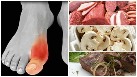 Alimentos que debes evitar si tienes gota