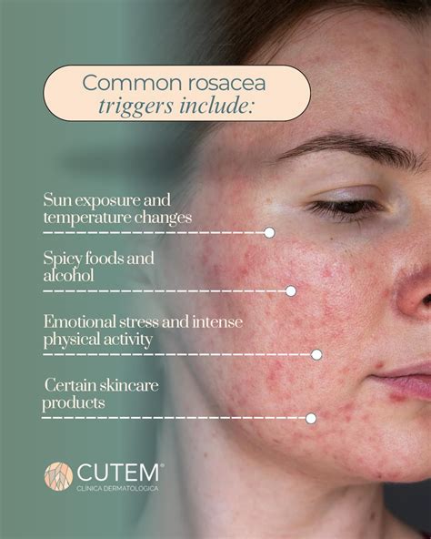 Alimentos que pueden desencadenar la rosácea