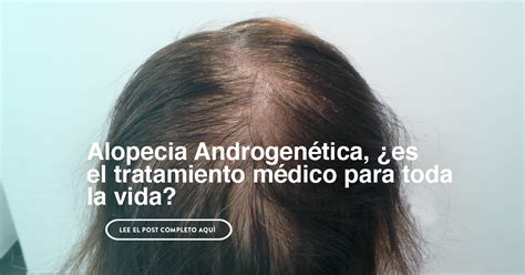 Alopecia androgenética
