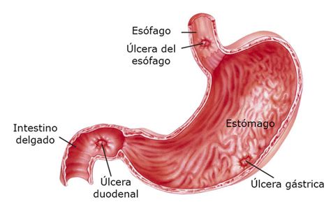 Anatomía de una úlcera estomacal
