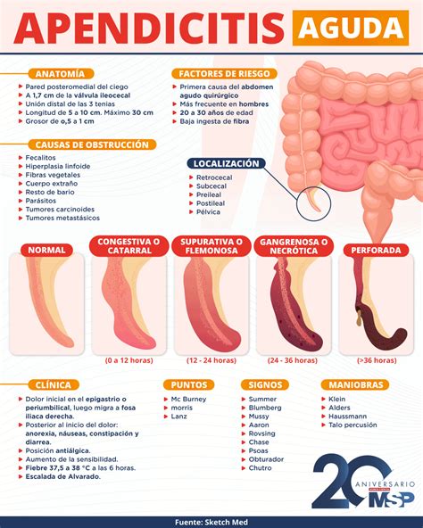Apendicitis