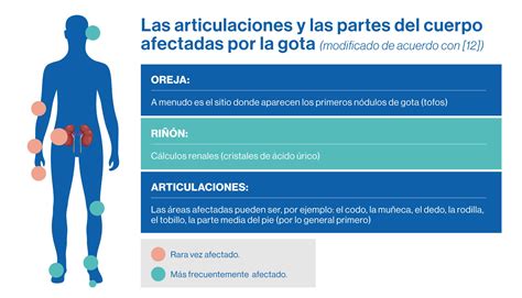 Articulaciones afectadas por la gota