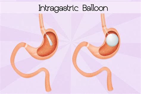 Balón Intragástrico Ingerible