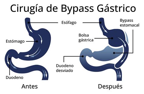 Bypass Gástrico