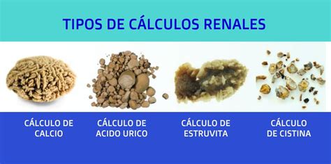 Cálculos Renales