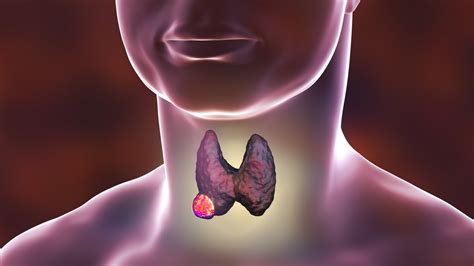 Cáncer de Tiroides