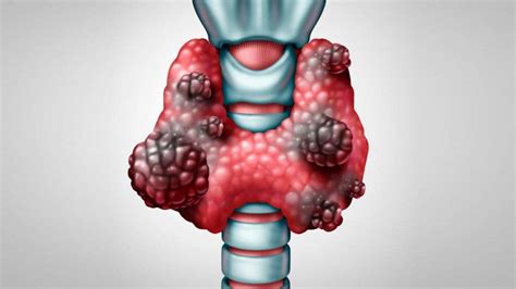 Cáncer de tiroides