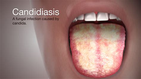 Candidiasis
