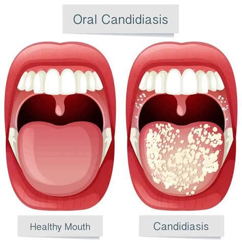 Candidiasis Oral