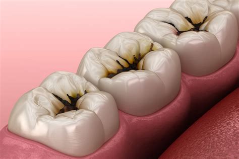 Caries dentales