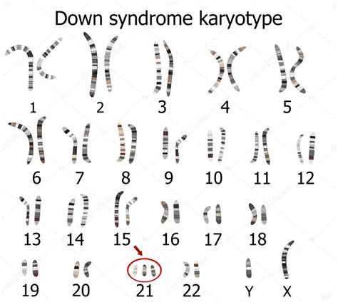 Cariotipo de paciente con síndrome de Down