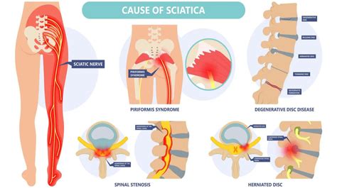 Ciática