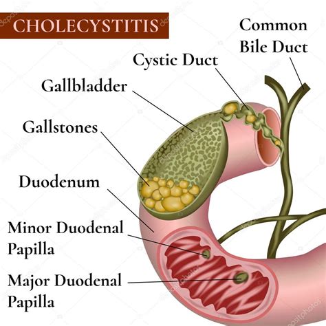 Colelitiasis