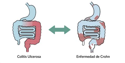 Comparación de la enfermedad de Crohn y la colitis ulcerosa