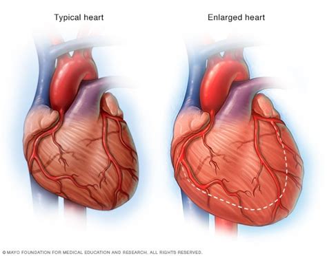 Corazón agrandado