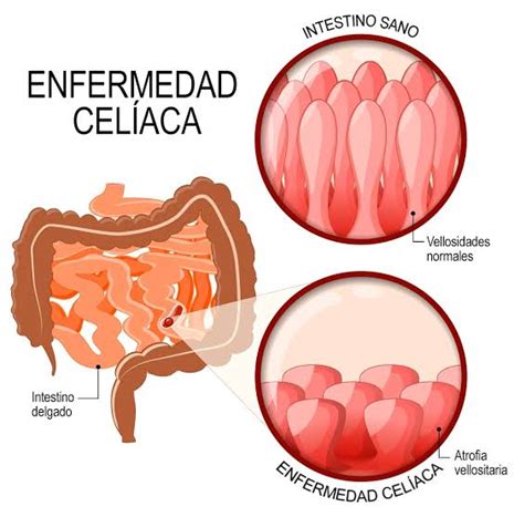 Daño en las vellosidades intestinales debido a la enfermedad celíaca