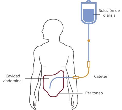 Diálisis Peritoneal