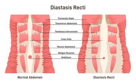 Diástasis abdominal