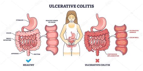 Diagrama de la Colitis Ulcerosa