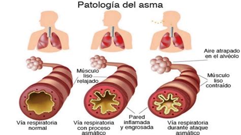 Dieta para el asma
