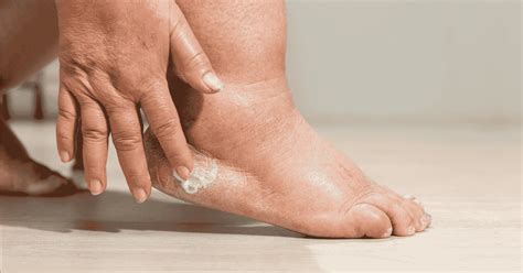 Edema en pies y tobillos