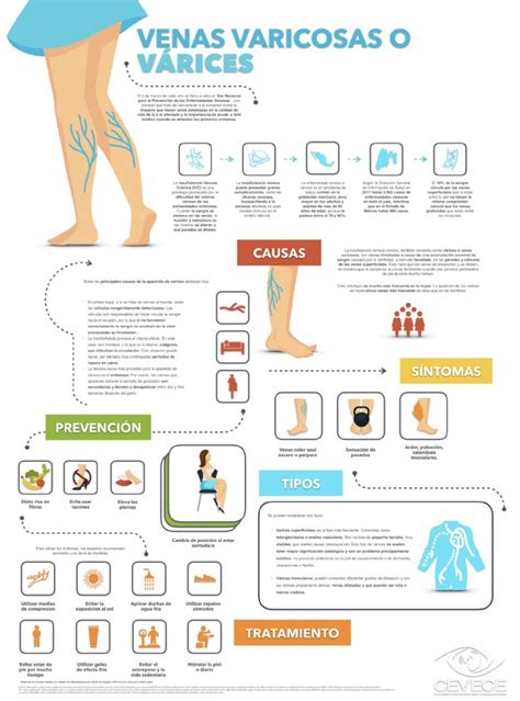 Ejercicios para várices