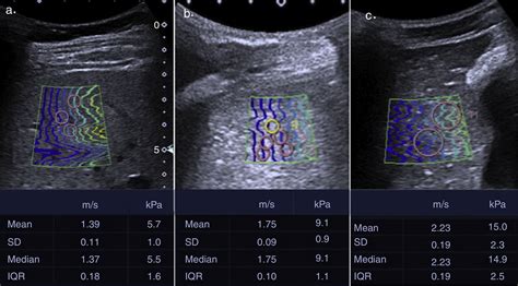 Elastografía hepática