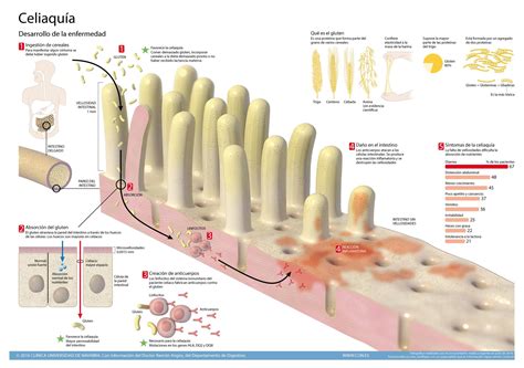 Enfermedad Celiaca