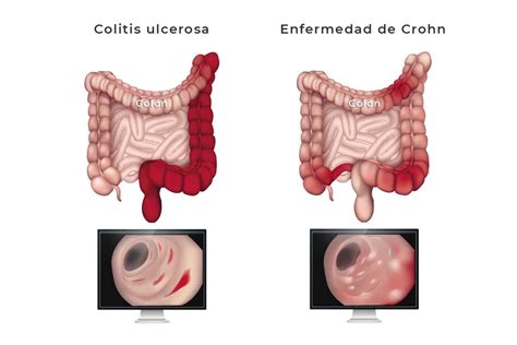 Enfermedad Inflamatoria Intestinal (EII)