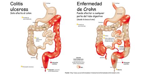 Enfermedad de Crohn y Colitis Ulcerosa