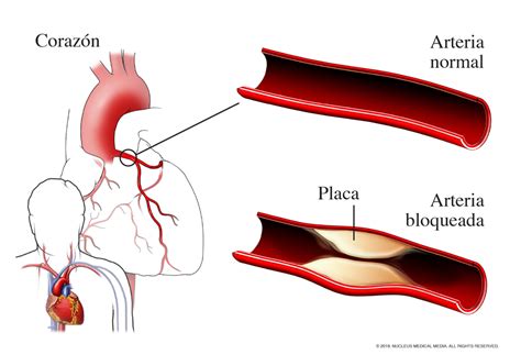 Enfermedad de la arteria coronaria