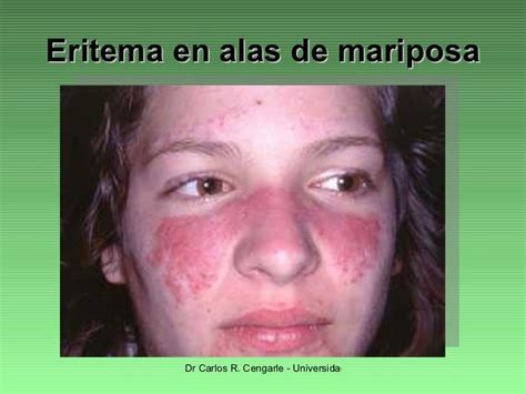Eritema en alas de mariposa, síntoma común del lupus