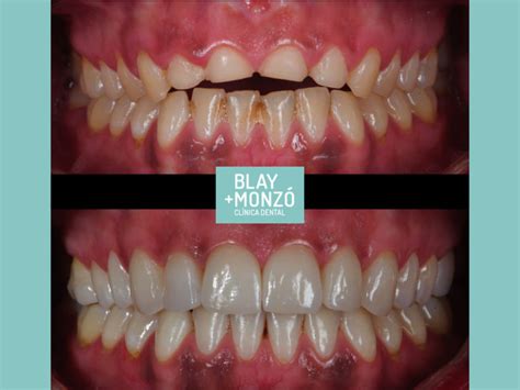 Erosión dental por bulimia