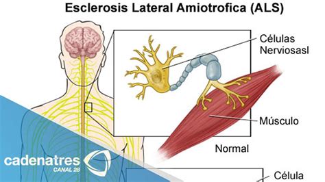 Esclerosis Lateral Amiotrófica