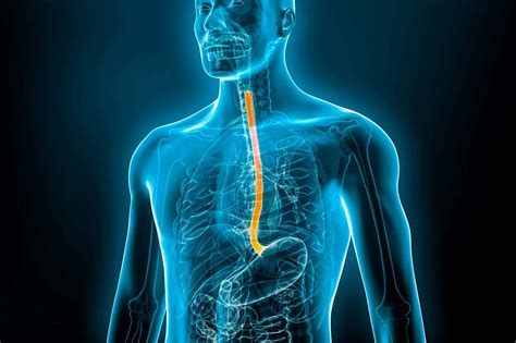 Esofagitis
