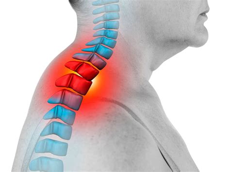 Espondilitis Anquilosante