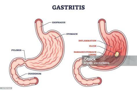 Esquema de Gastritis
