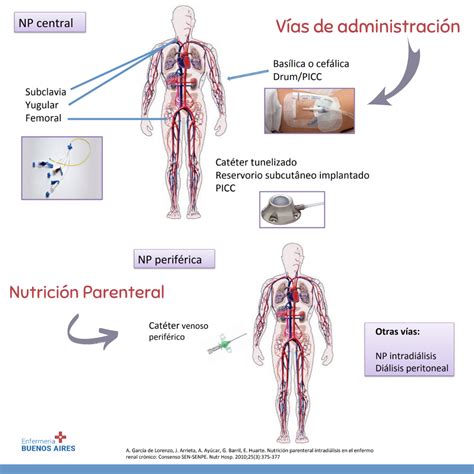 Esquema de administración de nutrición parenteral