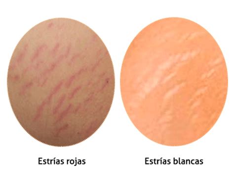 Estrías rojas y blancas