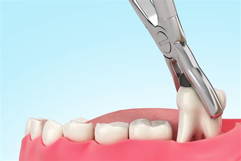 Extracción dental