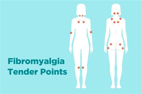 Fibromialgia