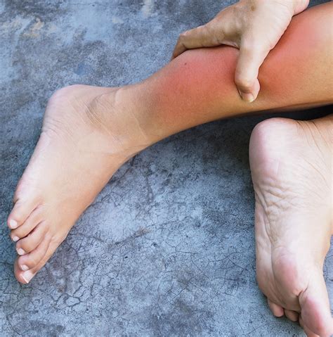 Flebitis