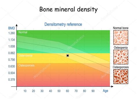 Gráfico de Densidad Ósea