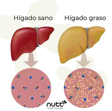 Hígado graso no alcohólico en niños