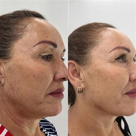 HIFU Facial Antes y Después